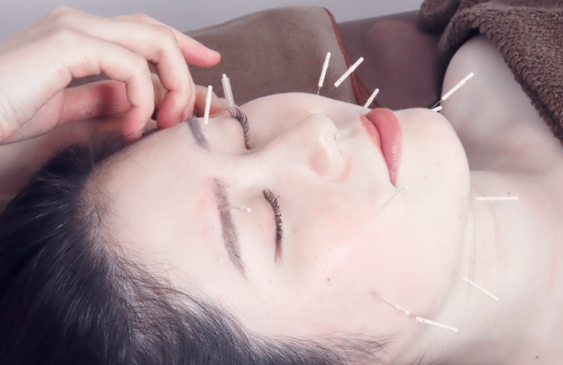 美容鍼を受ける女性